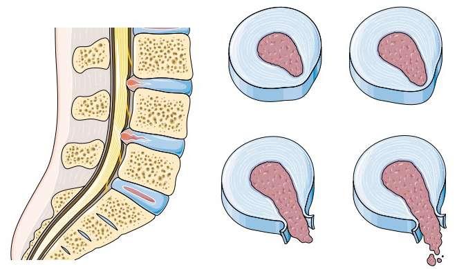 Hernie discale