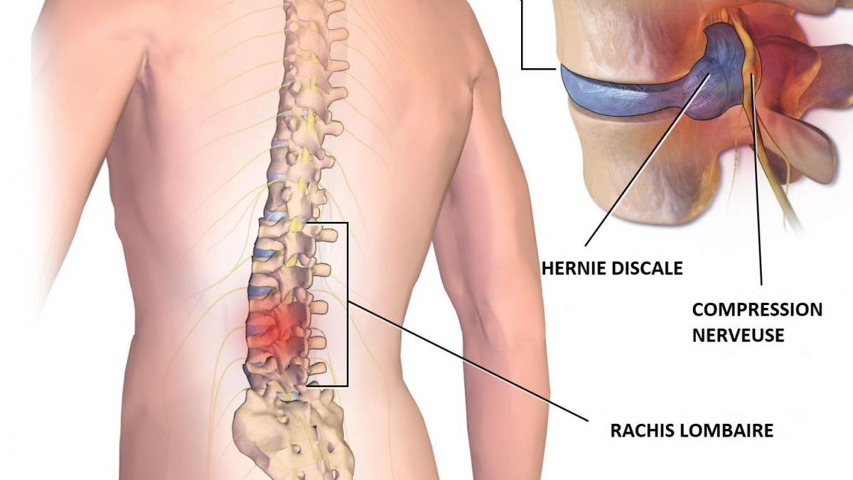 La hernie discale et l'ostéopathie