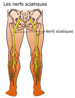 Sciatique 2